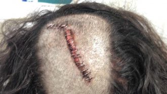 Heridas del escalador que recibió el impacto de una piedra a pesar de llevar casco.